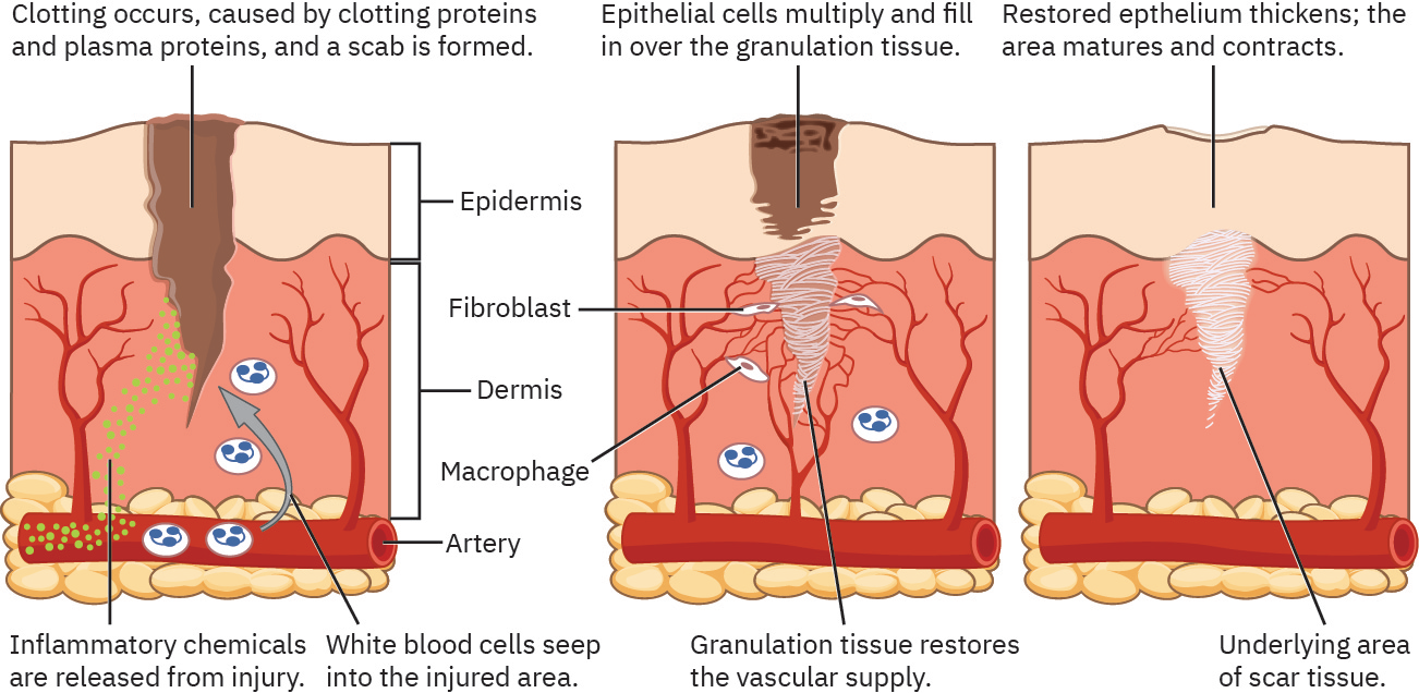 염증에서 증식, 반흔 성숙으로 이어지는 상처 치유 진행