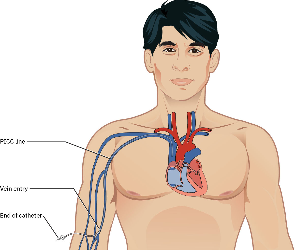 상완 삽입 정맥에서 상대정맥 근처 중심 팁 위치로 이어지는 PICC 경로