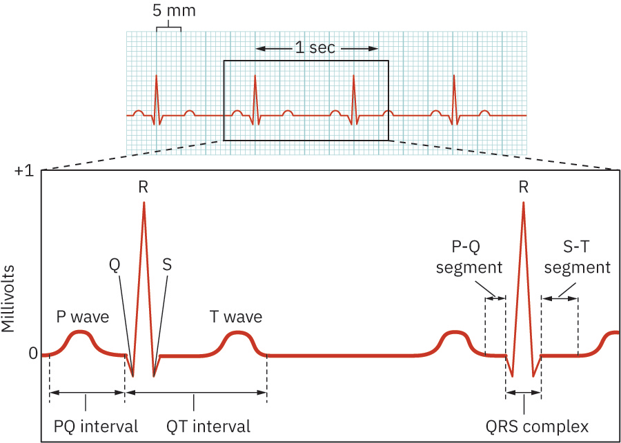 P 파, QRS 복합체, ST 분절, QT 간격을 포함한 ECG 파형 구성요소와 간격 표지
