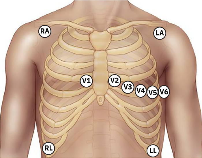 12유도 ECG 사지 및 흉부 전극 배치도(RA, LA, RL, LL, V1-V6)