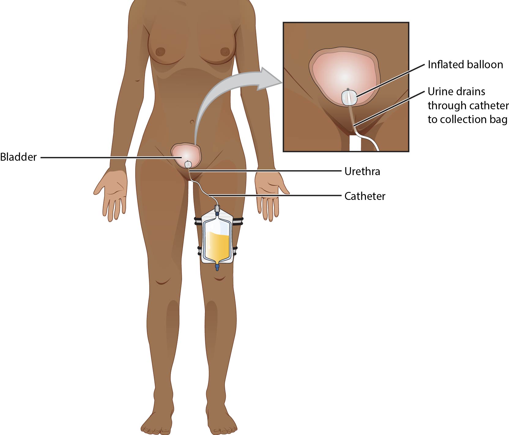 여성 유치도뇨관의 해부학적 경로와 풍선 포트