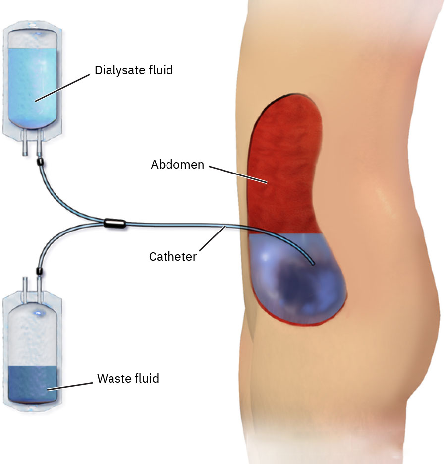 복부 카테터를 통한 복막투석액 유입 및 유출