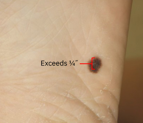 1/4인치 초과 직경 기준을 강조한 ABCDE 흑색종 선별 예시