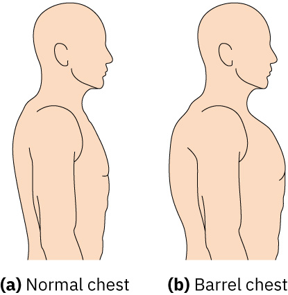 만성 과팽창과 연관된 barrel chest 양상과 정상 흉곽 형태의 비교