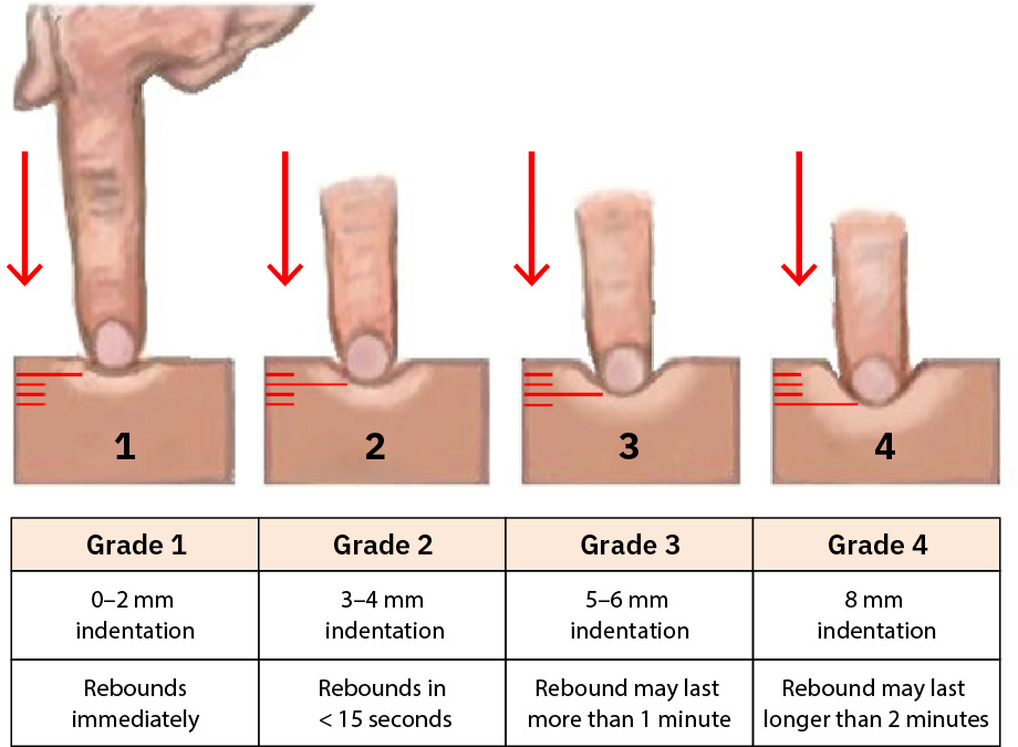 함몰 깊이와 반동 시간 단서를 포함한 grade 1부터 grade 4까지 함요부종 등급