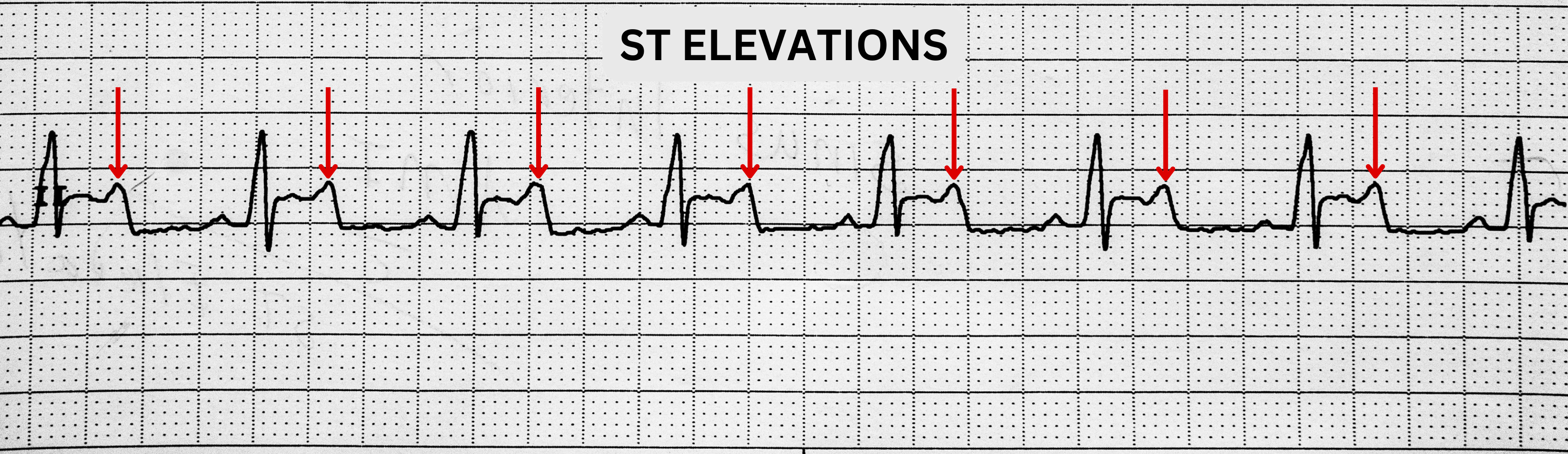 급성 심근 손상 양상을 시사하는 ST 분절 상승이 강조된 ECG 리듬 스트립