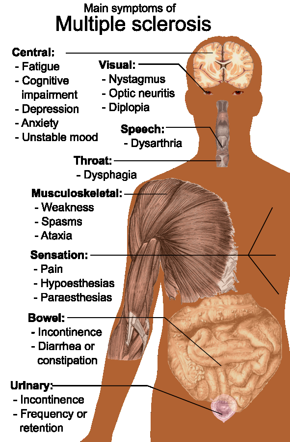 시각, 운동, 감각, 언어, 장, 비뇨기 증상을 포함한 다발성 경화증의 주요 증상 영역