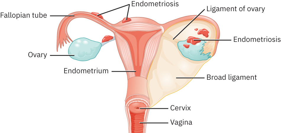 난소 및 복막 표면을 포함한 골반 생식 구조의 자궁내막증 병변