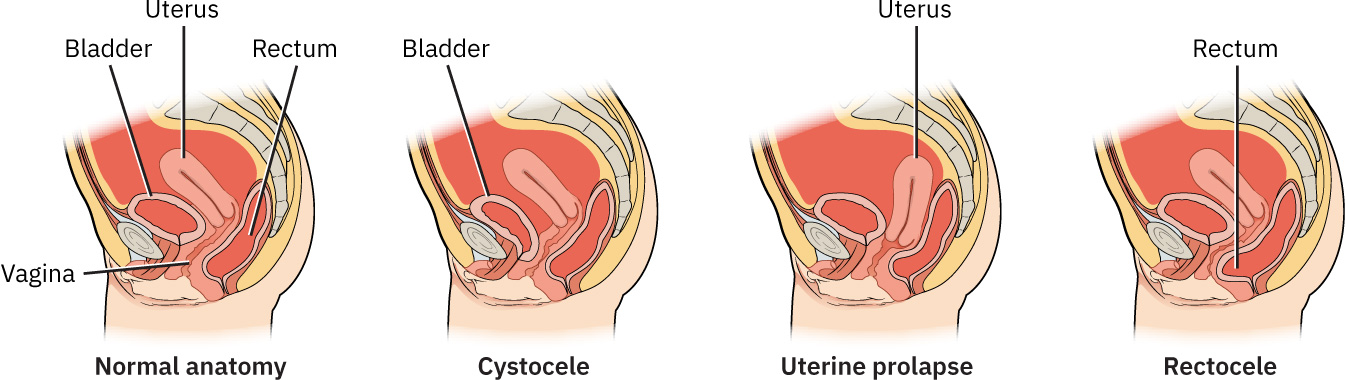 정상 해부학과 비교한 cystocele, 자궁탈출, rectocele의 골반 장기 탈출 양상