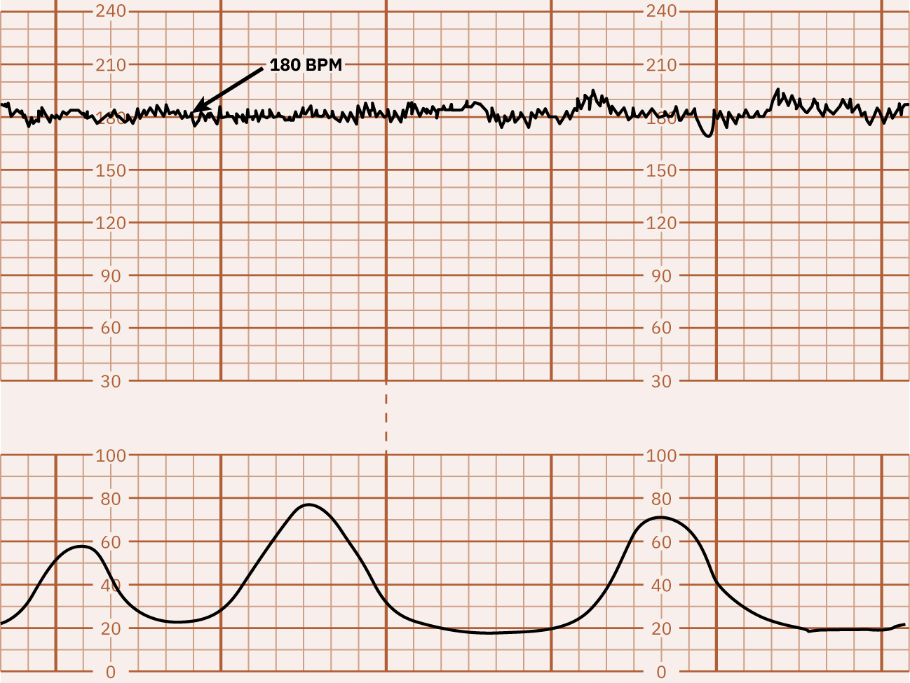 약 180 bpm 기저선 빈맥을 보여주는 FHR 추적 예시