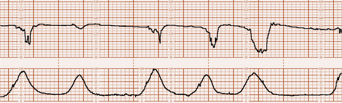 수축 전반에 걸쳐 급격한 하강과 회복 양상을 보이는 반복 가변 감퇴 추적