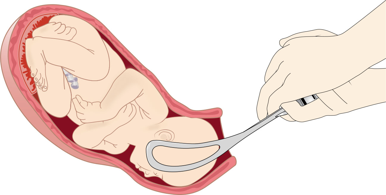 수술적 질식분만 중 태아 머리에 조절된 견인을 가하는 겸자 보조 분만 그림