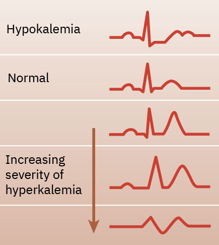 Progresion de ECG que compara hipopotasemia basal y patrones de gravedad creciente en hiperpotasemia