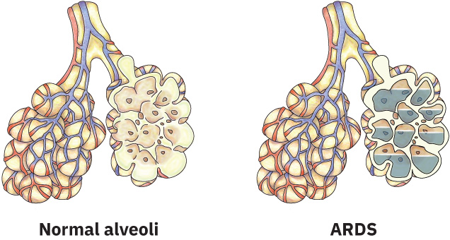 염증성 체액 충만과 가스교환 장애를 보이는 ARDS 폐포와 정상 폐포 비교