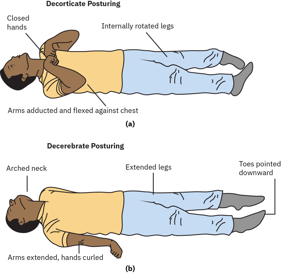 고중증 신경학적 악화 단서인 피질제거 자세와 제뇌 자세 비교