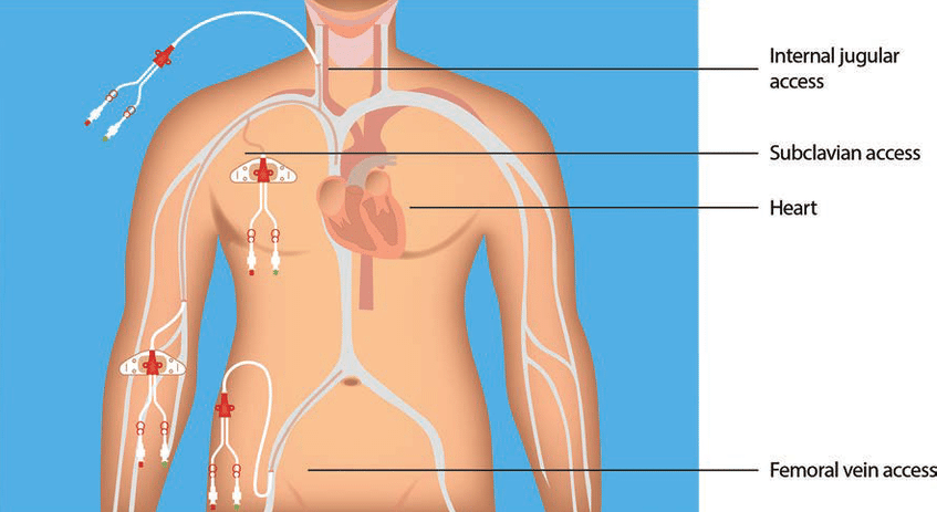 내경정맥 쇄골하정맥 대퇴정맥 접근을 보여주는 흔한 중심정맥 접근 경로