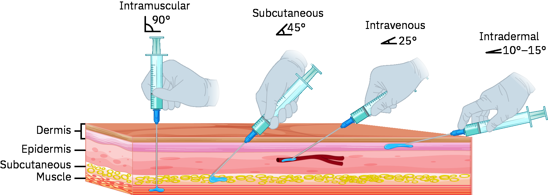 피내·피하·근육내·정맥내 경로의 주사 각도 비교