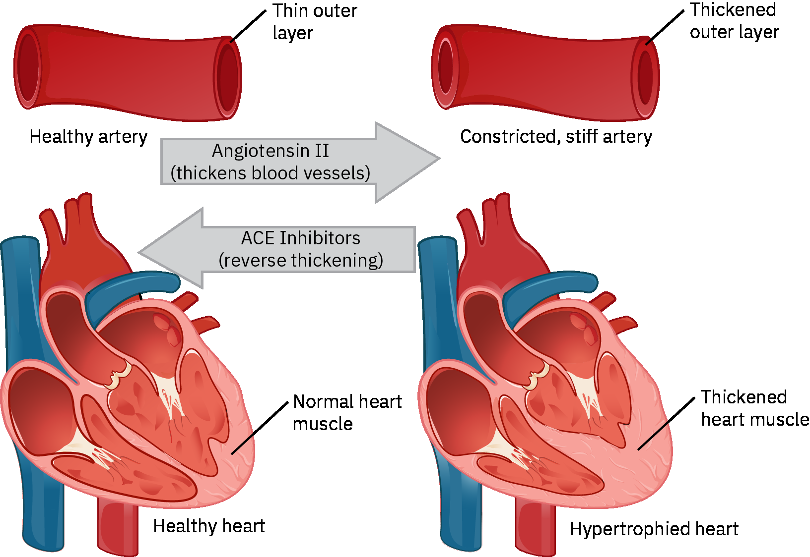 Modelo del efecto de inhibidores de la ECA que compara el estado vasoconstricto del RAAS con el tono arterial mejorado y la reducción de la carga cardíaca después del bloqueo de la ECA