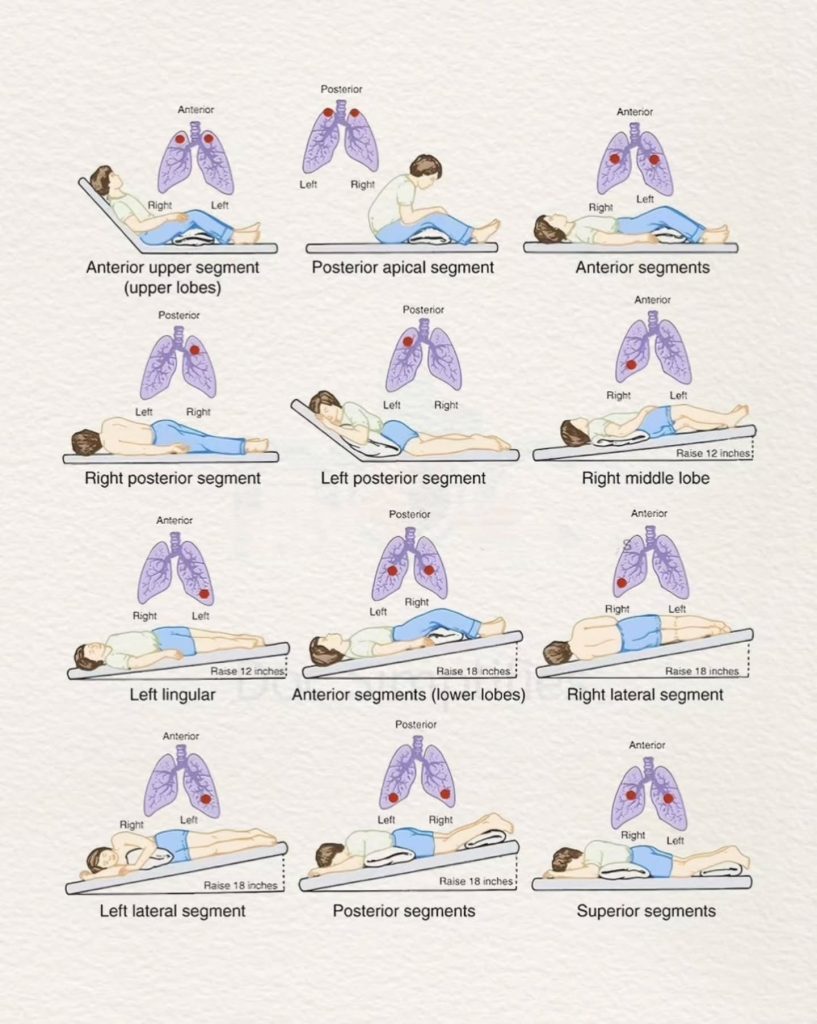 중력 보조 분비물 이동을 위한 폐 분절별 체위 배액 지도