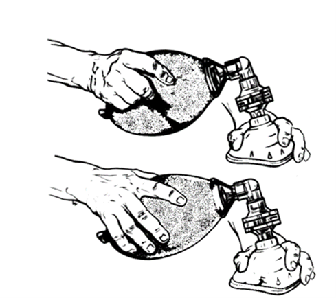 효과적인 흉곽 상승을 위한 조절된 백 압박을 보여주는 수동 소생기 손 압박 기법